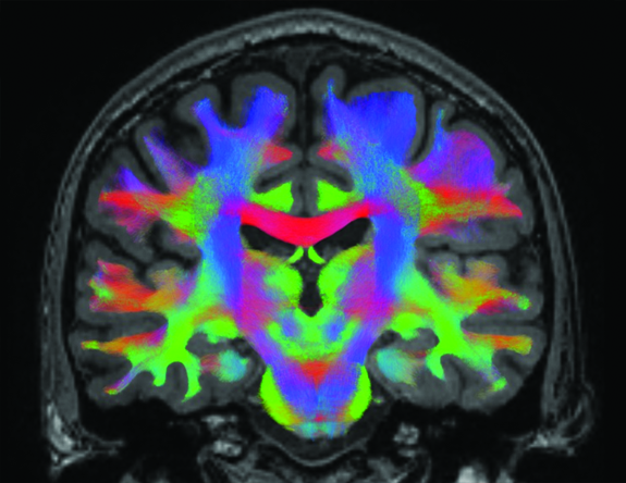 image of a scanned brain showing a lengthwise view from ear to ear, showing the groves and indentations of the person’s brain