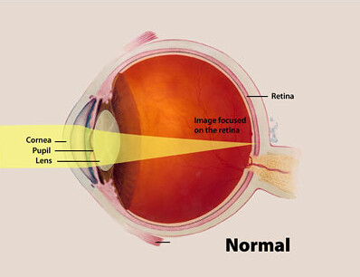 A color illustration of the eye highlighting the cornea, pupil and lens, and the way an image focuses on the retina.