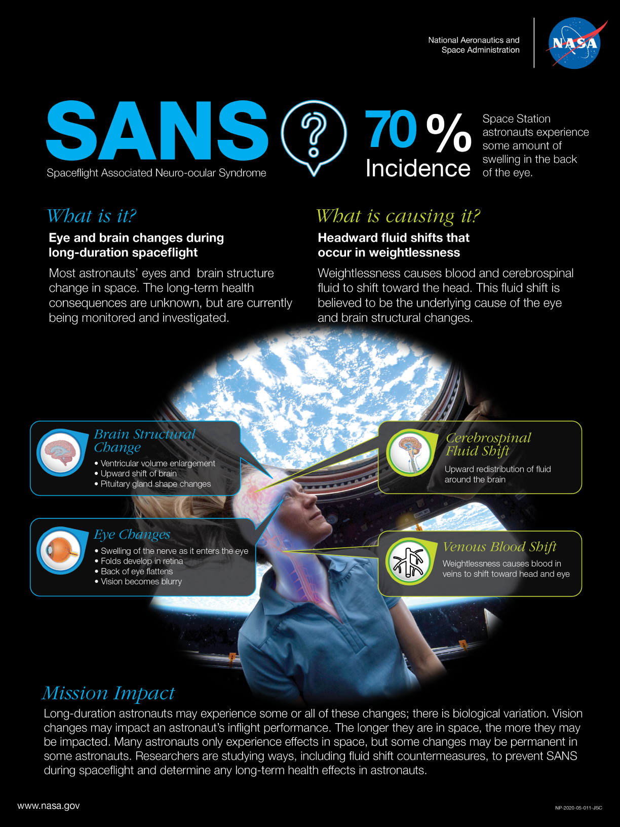 Spaceflight Associated Neuro-ocular Syndrome (SANS) Infographic