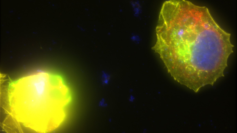This image shows immunofluorescence of breast cancer cells treated with a MicroQuin therapeutic. Staining shows a normal nucleus (blue) and the therapeutic (green) localized to the cell’s endoplasmic reticulum (red). The drug forces the cytoskeleton (yellow) to collapse, inducing cell death. Credits: Scott Robinson, MicroQuin.