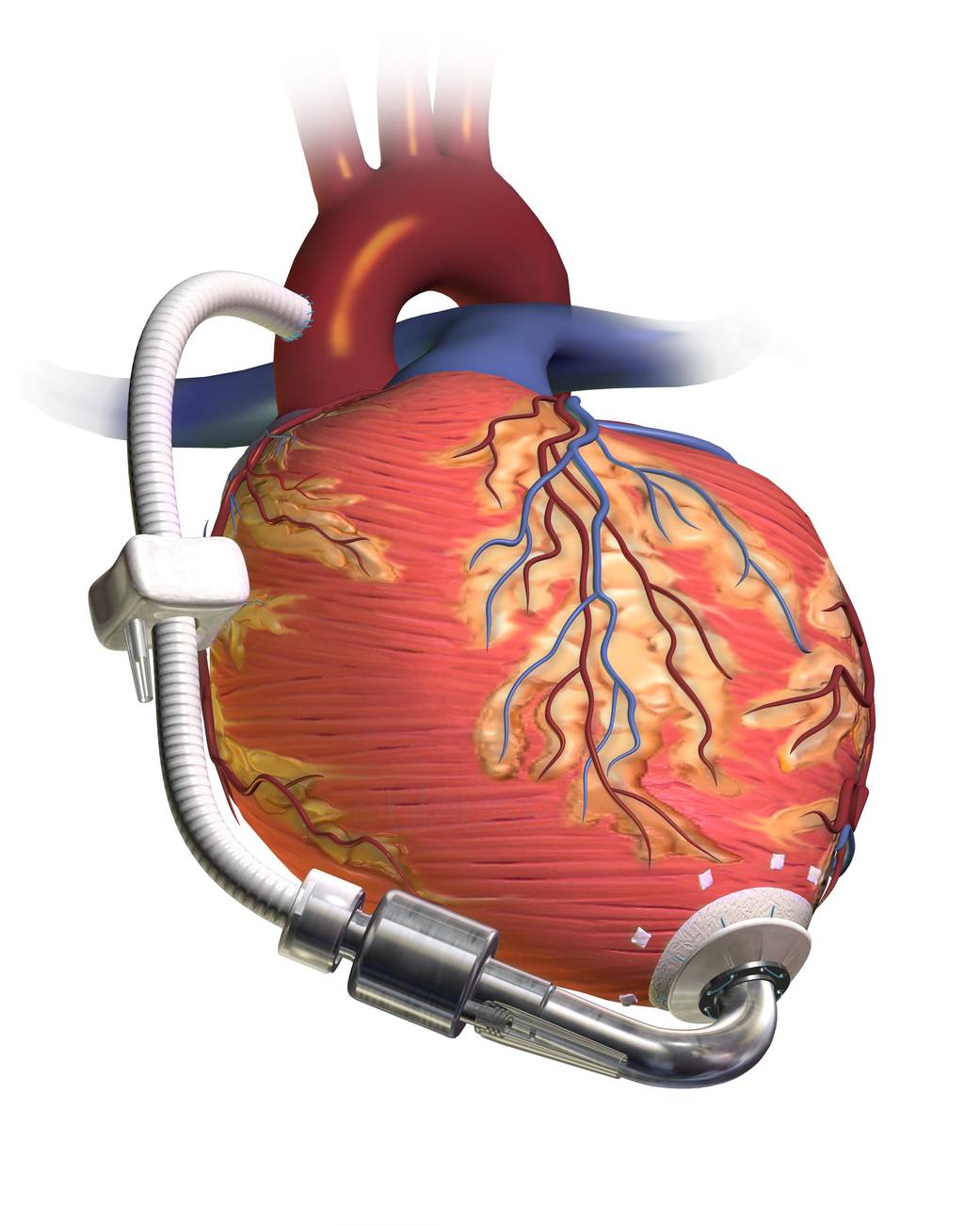 Cardiac Pump