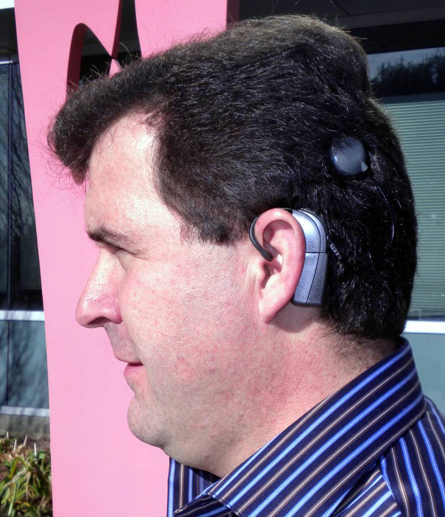 Cochlear Implants