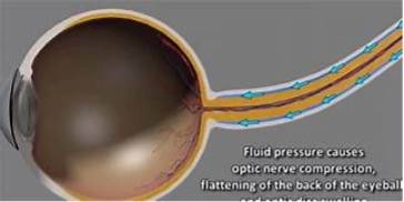 diagram of an eye with damage to optic nerves from time in space