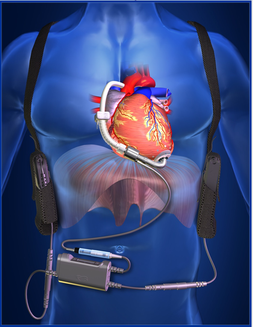 2001 Ventricular Assist Device