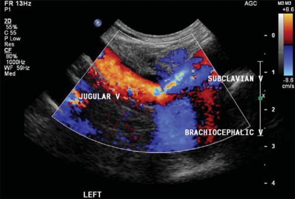 doppler, VTE, SANS, venous thrombosis, medical, health