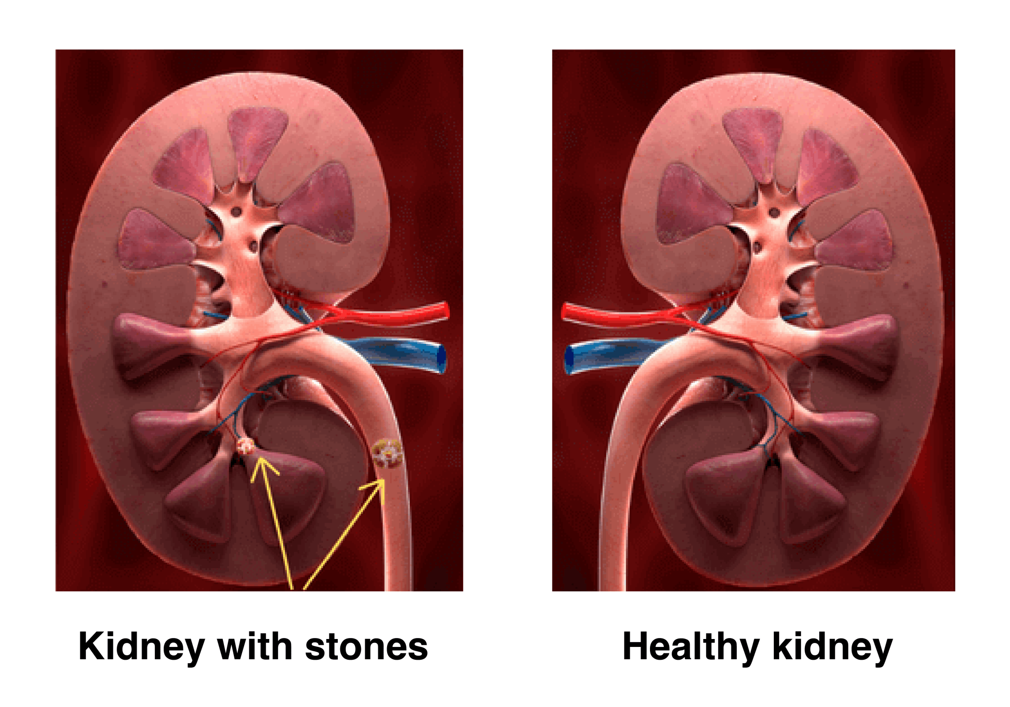 Kidney with stones vs healthy kidney