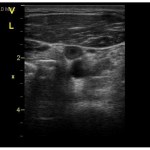 Establishing a VTE Risk Score for Astronauts Algorithm