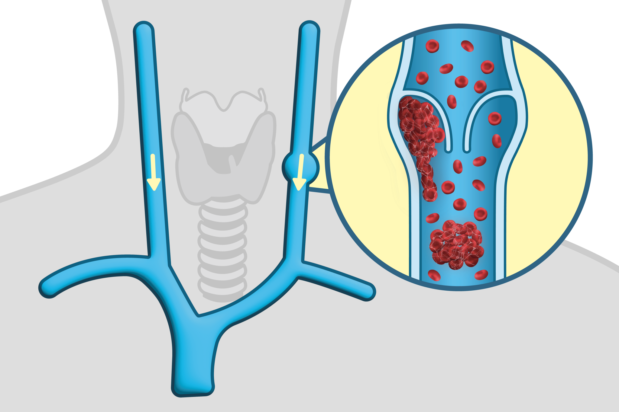 VTE, thrombosis, spaceflight